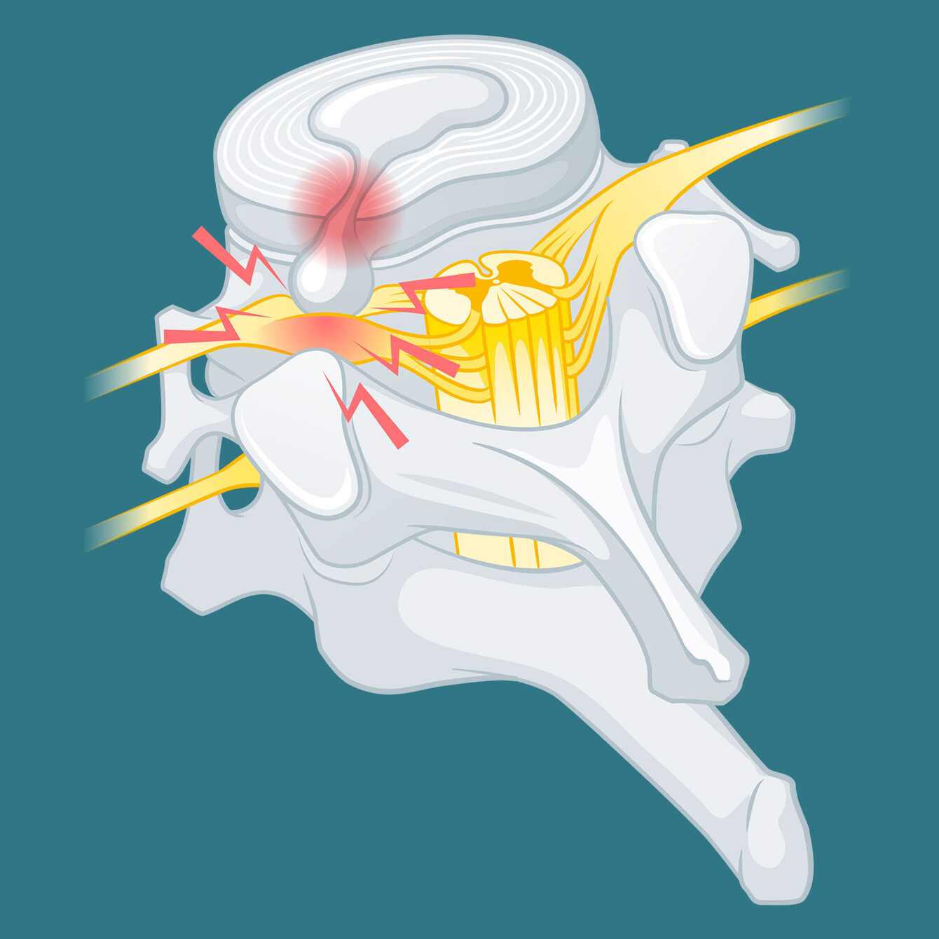 Illustration 3D Ansicht von einem Wirbel und Nervenbahnen